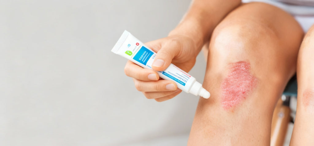 Hormonal and Non-Hormonal Ointments for Skin Conditions and Allergies